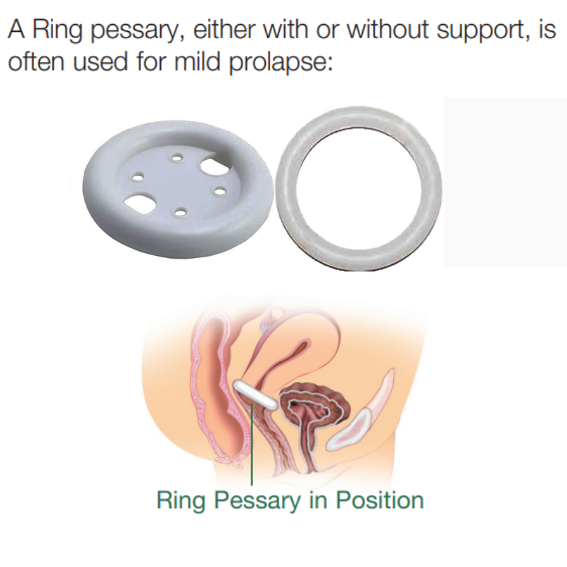 The ring pessary is commonly used to treat cystocele. 