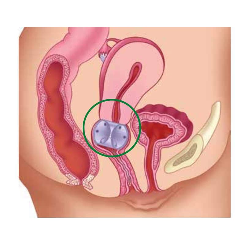 EvaCare Cube Pessary - Image 3