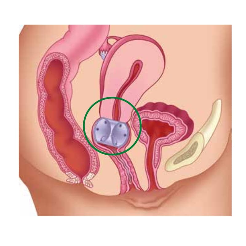 Integra Miltex Cube Pessary - Image 2