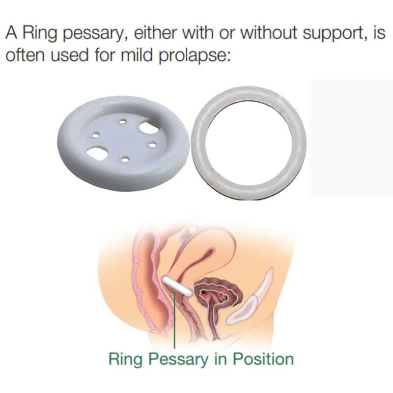 EvaCare Ring Pessary - Image 2