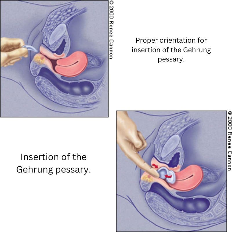 EvaCare Silicone Gehrung Pessary With Support - Image 2