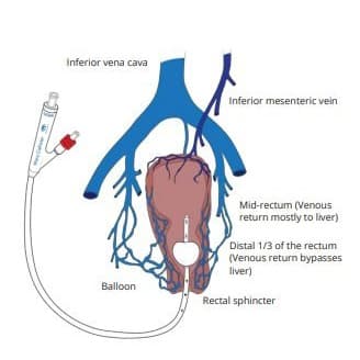 The Macy Catheter Rectal Medication Tube - Image 3