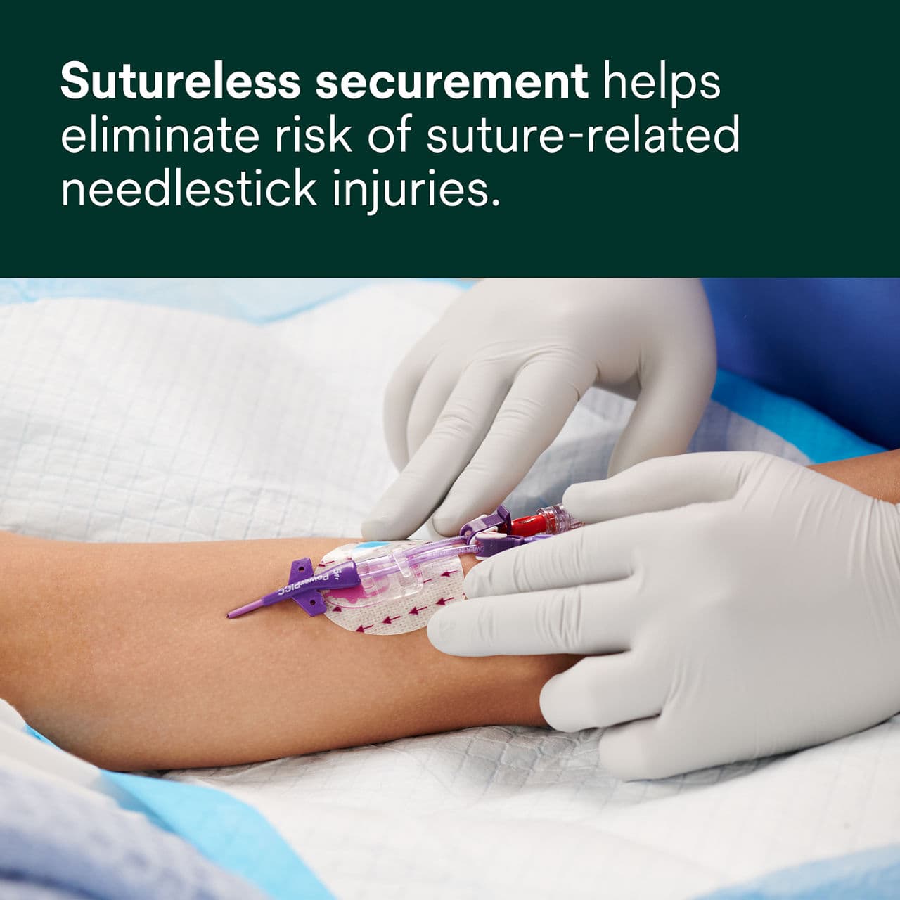 3M PICC / CVC Securement Device + Tegaderm I.V. Advanced Securement Dressing 3M PICC / CVC Securement Device + Tegaderm I.V. Advanced Securement Dressing