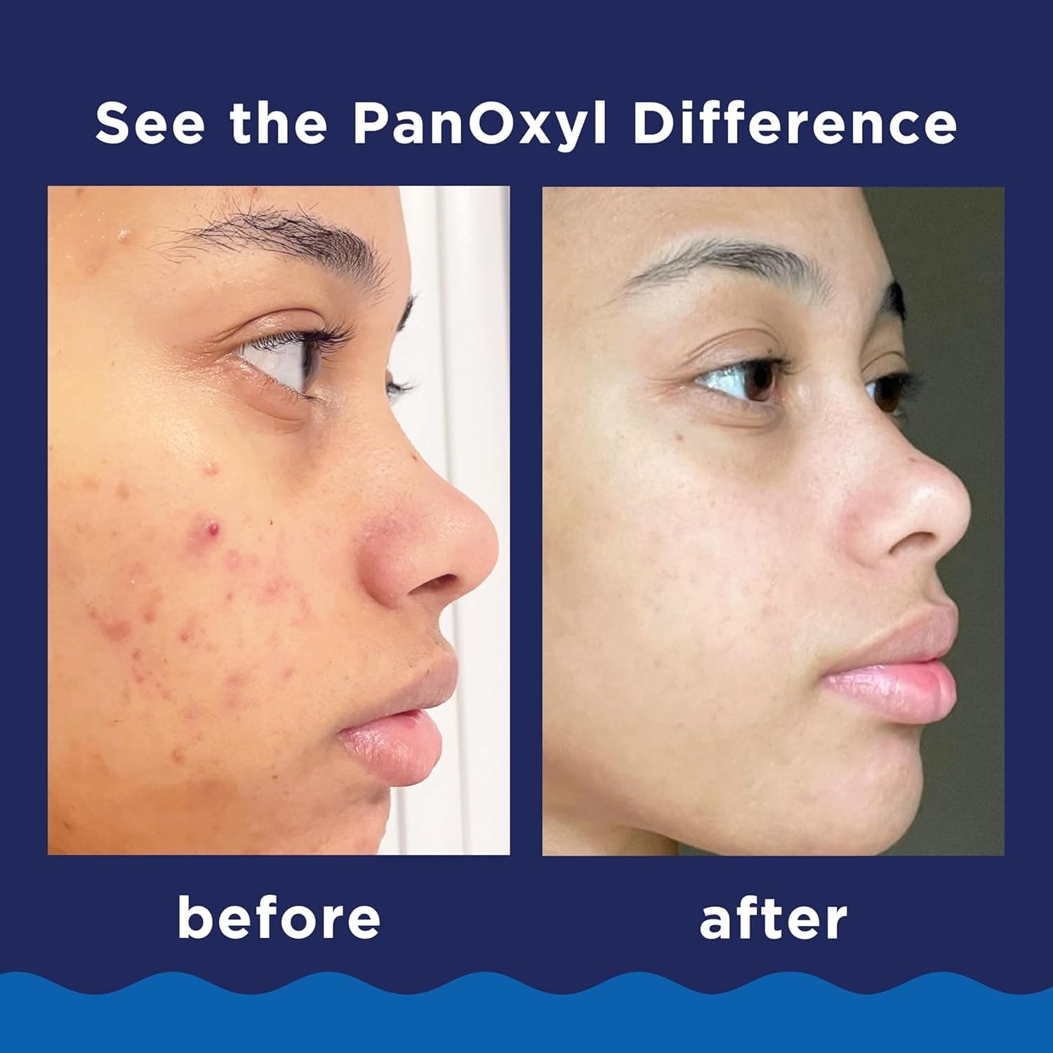 PanOxyl Acne Foaming Wash - Image 7