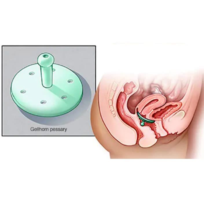 EvaCare Long Stem Gellhorn Pessary - Image 2