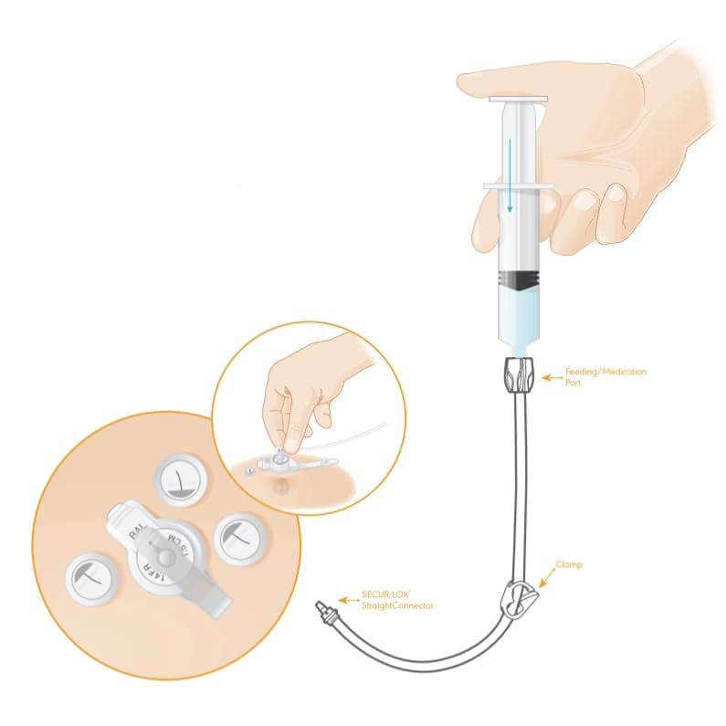 Mic-Key Low-Profile Gastrostomy Feeding Tube Kit, Non-Enfit - Image 4