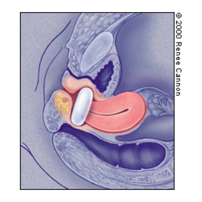 EvaCare Donut Pessary - Image 2