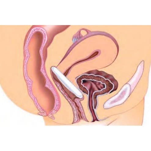 EvaCare Oval Pessary with Support - Image 2